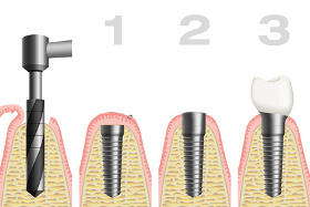 Dental Implants Procedure