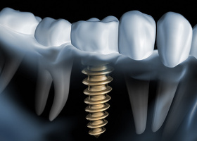 Dental Implants Turkey